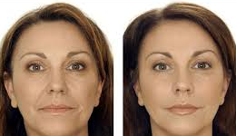 Wrinkels Treatment in Delhi