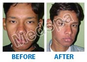acne treatment in delhi