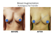 breast augmentaion surgery in Delhi