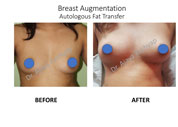 breast augmentaion surgery in India