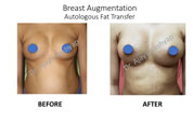 breast augmentaion in Delhi