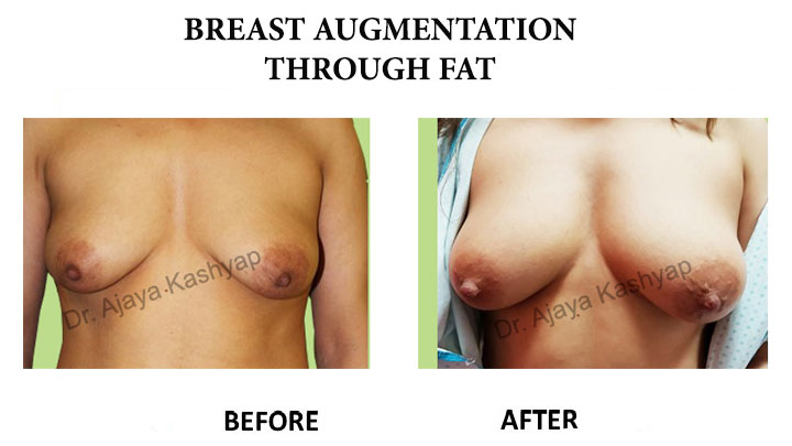 breast augmentaion