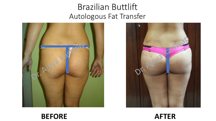 brazilian butt lift surgery in India