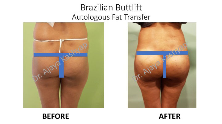 butt lift surgery in India
