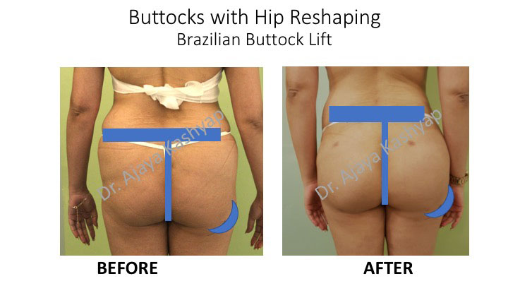 buttock lift surgery in Delhi