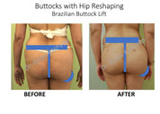 buttock augmentaion surgery in Delhi