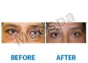 eyelid surgery in Delhi