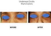 eyelid surgery in India
