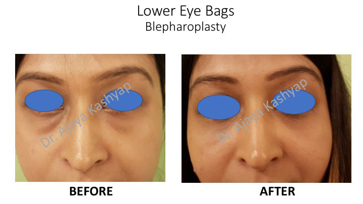 blepharoplasty surgery in India