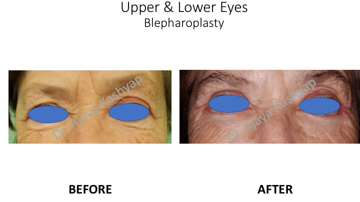 eyelid surgery in India