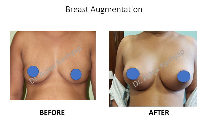 Breast Augmentation Surgery in India