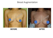 Breast Augmentation surgery in India