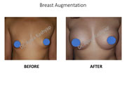 Breast Augmentation surgery Delhi