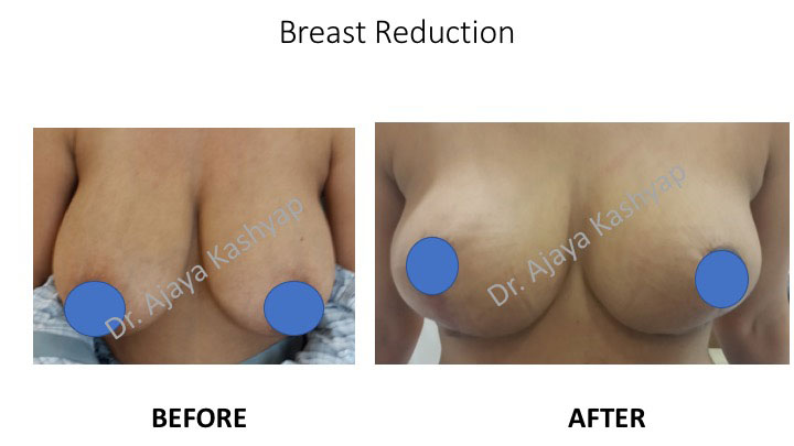 Breast Reduction Surgery in India