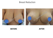 Breast Reduction surgery Delhi