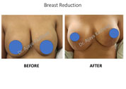 Breast Reduction surgery India
