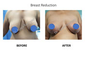 Breast Reduction in Delhi