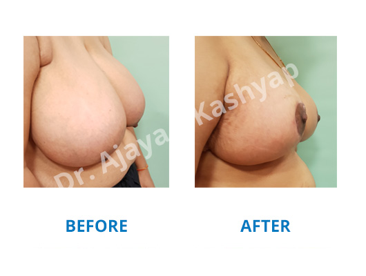 Breast Reduction surgery in India