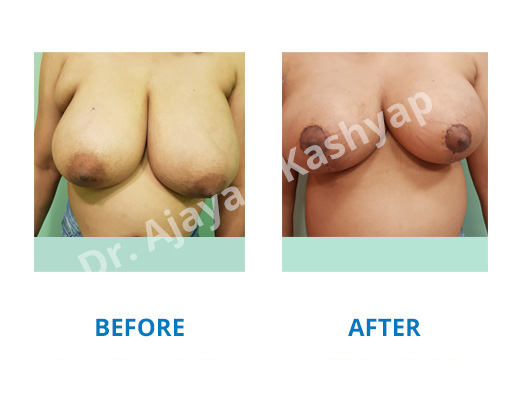 Breast Reduction surgery in Delhi