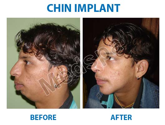 chin implant cost in Delhi