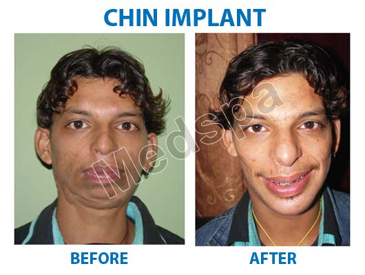 chin surgery in Delhi
