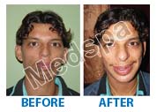 chin implant surgery in Delhi