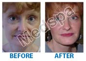 facelift surgery cost in India