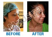 facelift surgery cost Delhi