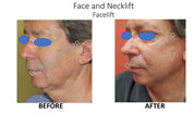 facelift surgery cost India