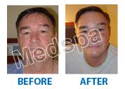 facelift surgery in India