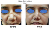 Filler treatment in India