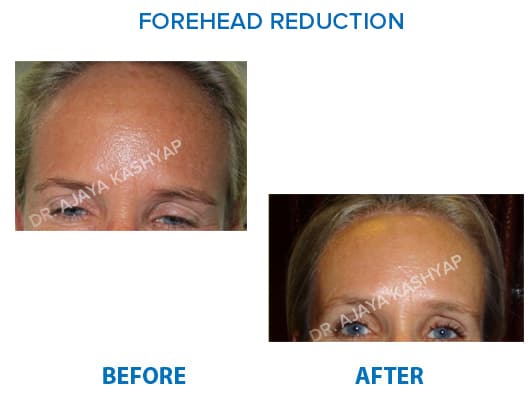 forehead Reduction Surgery in India