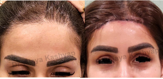Forehead Lift Surgery in Delhi