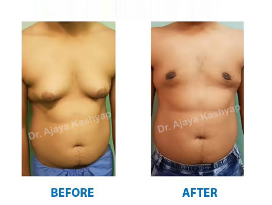 male breast reduction surgery in Delhi