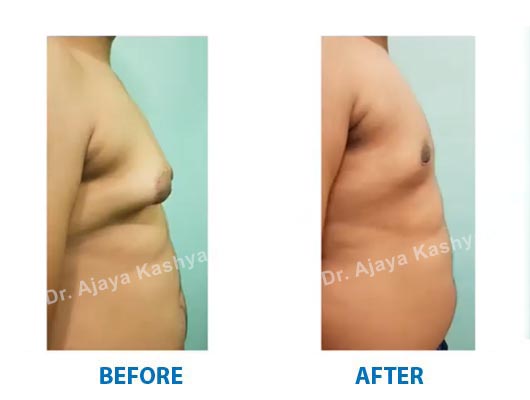 gynecomastia Surgery in India