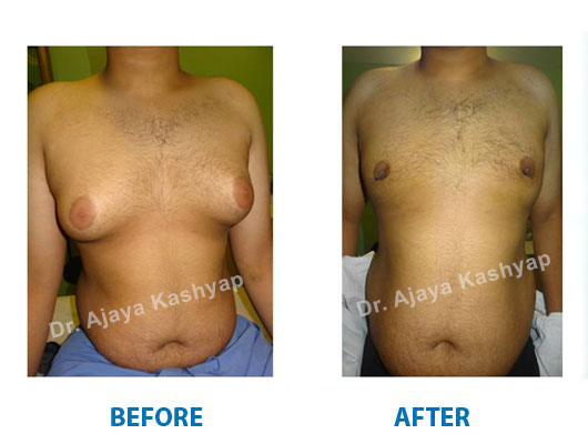 gynecomastia Surgery cost in Delhi