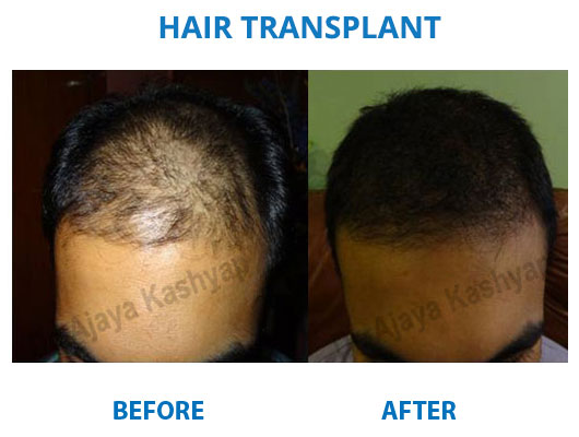 Hair Transplant Surgery in Delhi