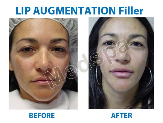 lip augmentation surgery in India