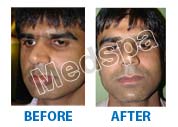lip augmentaion surgery in Delhi