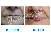 lip augmentaion surgery in India