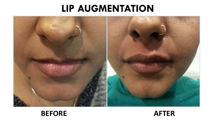 Lip Augmentation Surgery in Delhi