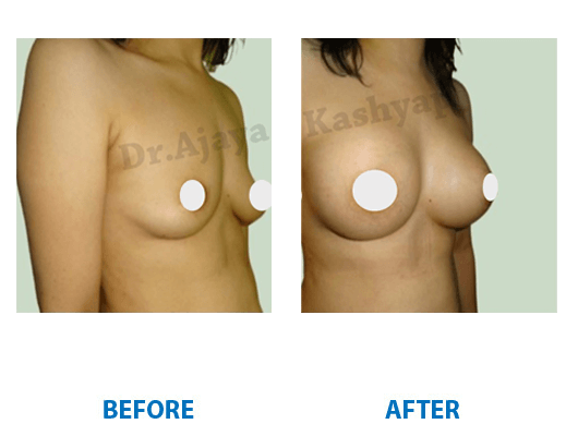 Breast Augmentation surgery India