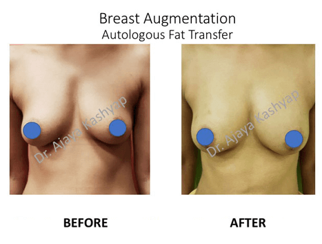 Breast Augmentation surgery India