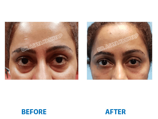 Filler treatment in India