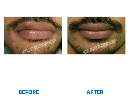 Lip Reduction Surgery in India