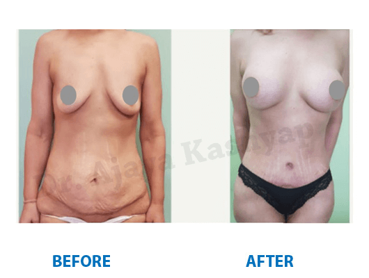 mommy makeover Surgery in India