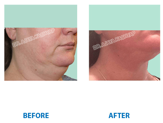neck and facelift