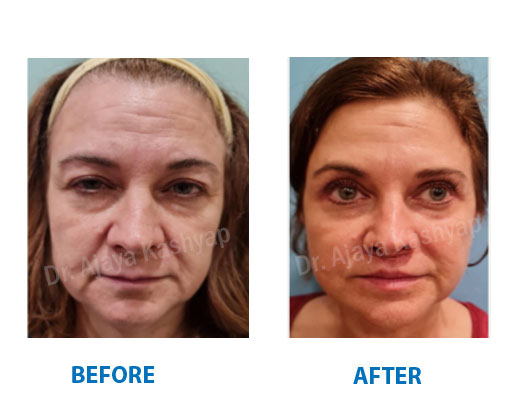 facelift surgery cost India