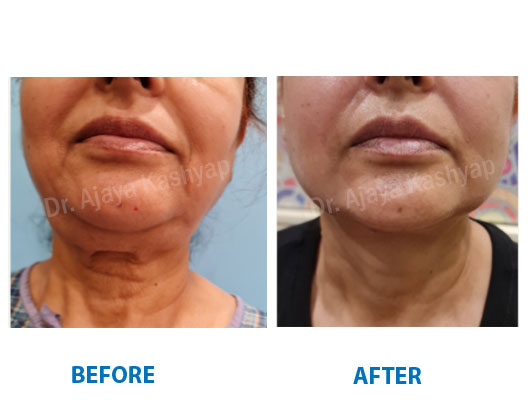 neck lift surgery in India
